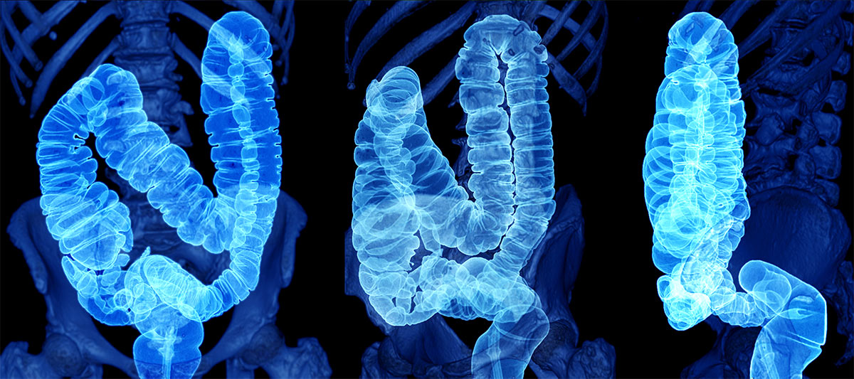 Image d'un intestin, composée à partir de clichés de tomodensitométrie